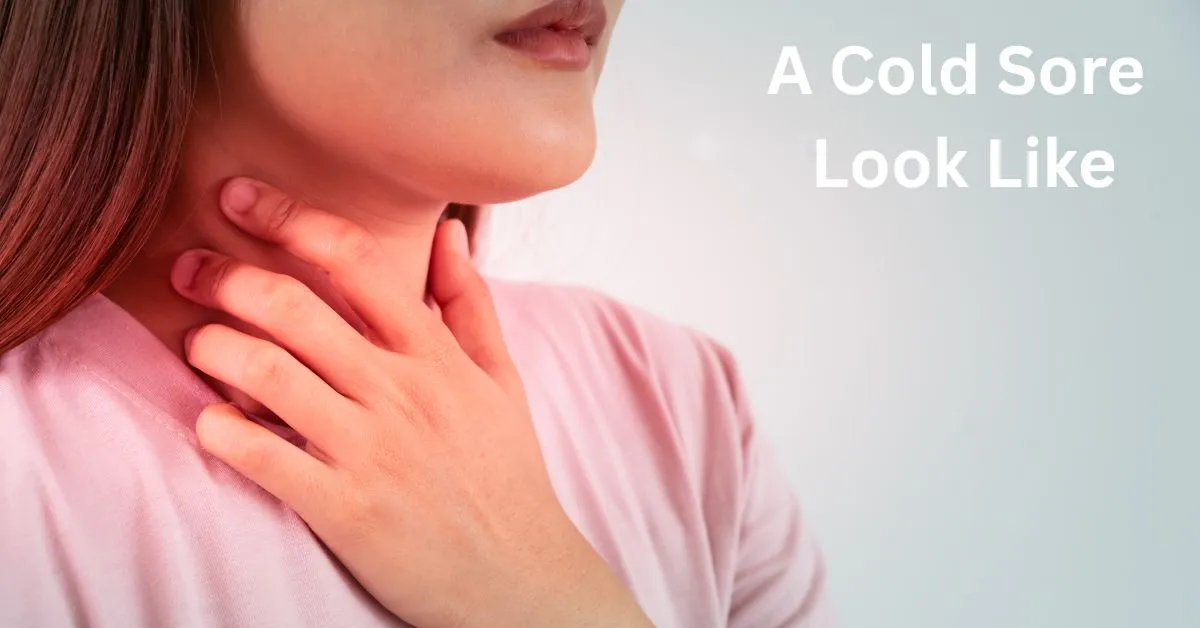 A Cold Sore Look Like