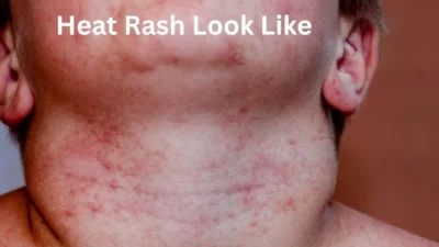 Heat Rash Look Like