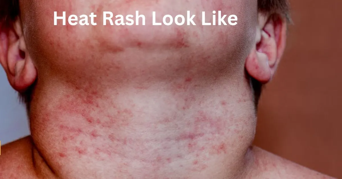 Heat Rash Look Like