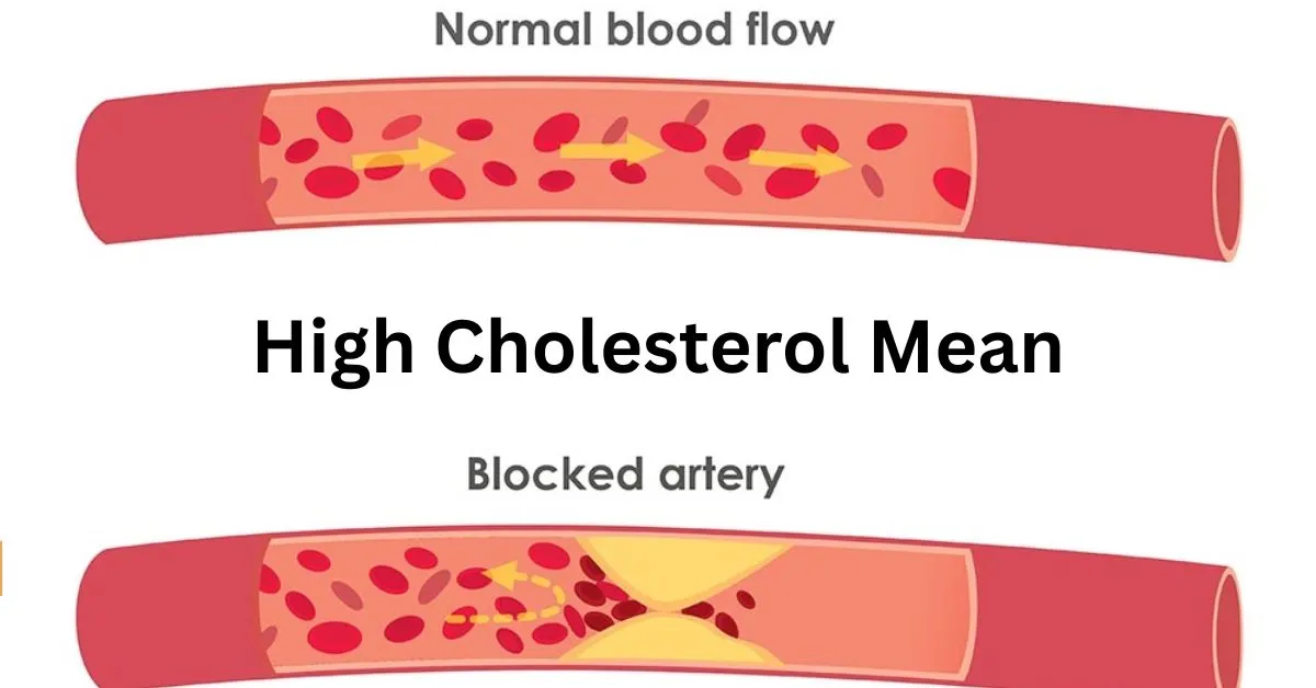 High Cholesterol Mean